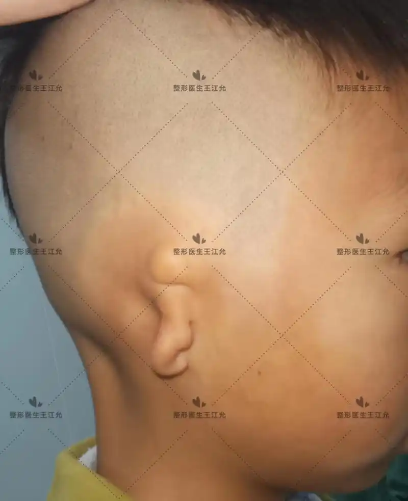 虽然小耳畸形不会导致全聋,但患者会有重度的听力障碍.