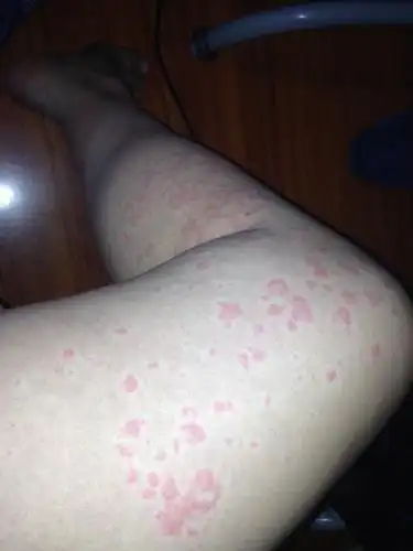 身上皮肤过敏,用什么药?可以热水洗澡吗?