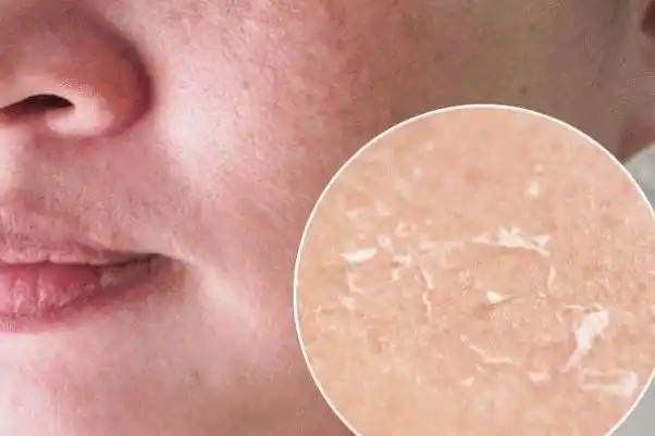 皮肤干燥脱皮严重像鱼鳞怎么办皮肤干燥起皮像鱼鳞是怎么回事