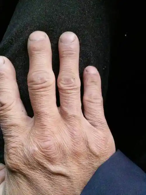 我右手中指关节肿痛白天干点活肿消点,过晚上第二天又肿痛,手指不能伸