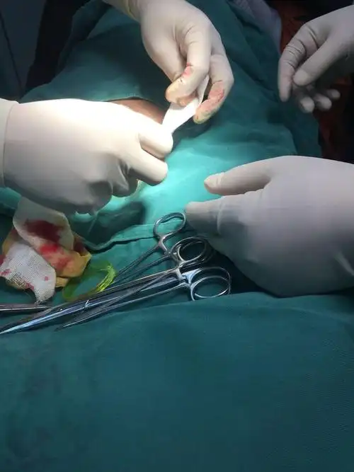 随访 讨论吻合器包皮环切术美观,操作方便,值得推荐,但其费用稍高,且