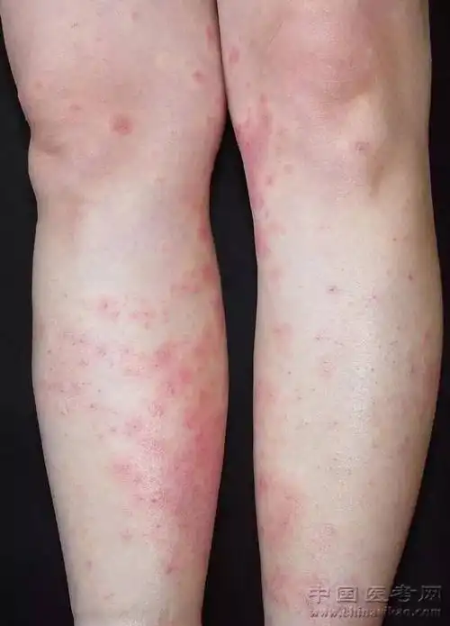 史上最全的皮肤病图谱吐血整理