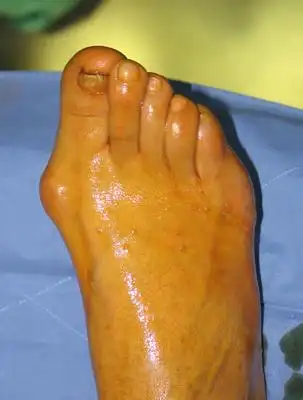 我的脚大拇指傍边突出的骨头一走路就痛,尤其是穿平底鞋,穿旅游鞋还能