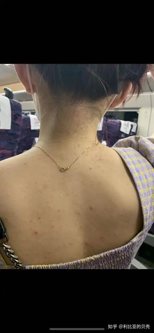 背上得了毛囊炎要多久才能好