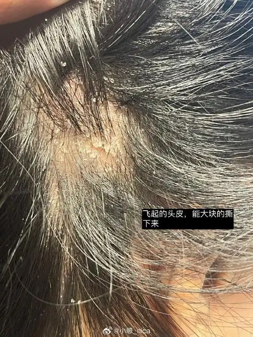 整理手机相册,看到我头皮银屑病最崩溃的时期.