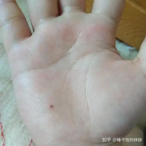 手掌突然长了两颗痣代表什么(手掌突然长了一颗痣是怎么回事)