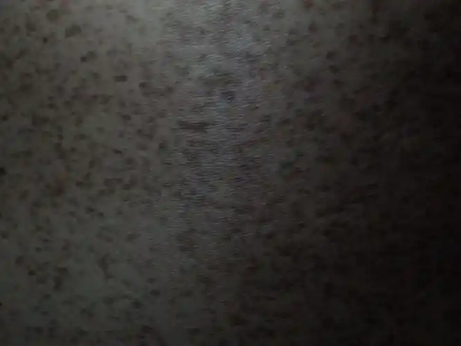 背上起的黑斑是什么东西