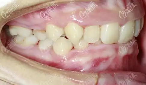 矫正前的牙齿侧面