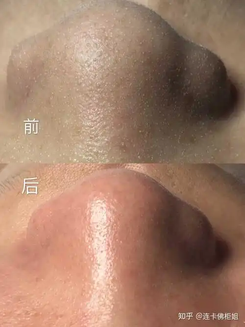 高中生用什么基础补水的水乳比较好啊,毛孔有点点大,然后有黑头,!