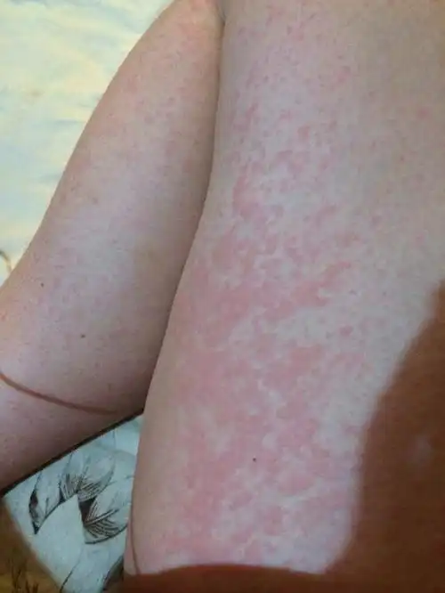 皮肤过敏怎么办教你几招轻松应对