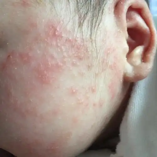 湿疹症状图片