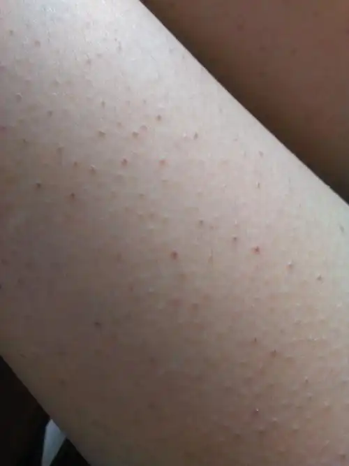 我的两个腿上都长好多这个东西,一年四季都这样好多年了,有人知道吗