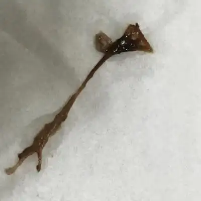 是流产先兆?还是正常分泌物排泄?