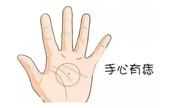 手掌有痣代表什么意思手掌痣主富贵