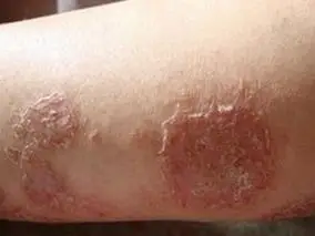 湿疹的症状及肤一清治疗方法有哪些