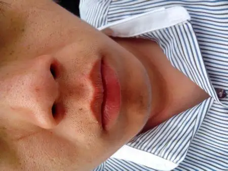 男生,毛孔粗大,有图片,谁能帮帮我