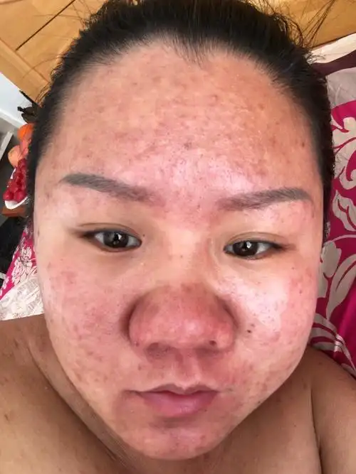 孕妇护肤什么牌子好 五大习惯诱发痘痘肌_小猪生活-女性生活 本地生活