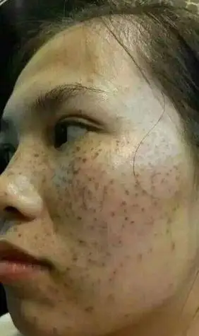 黑人女性面部长色斑图片