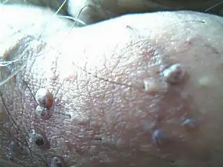 感染艾滋病毒生殖器会有什么症状,会出现疱疹吗