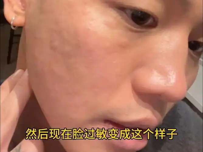 吃虾过敏!发誓以后再也不吃虾了!