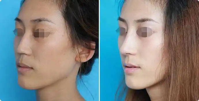 驼峰鼻矫正案例效果对比图