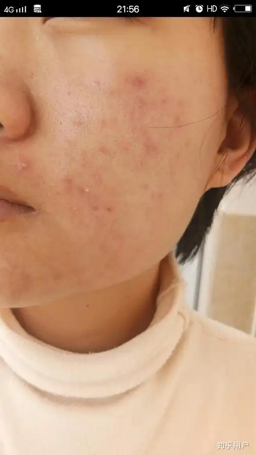 过度清洁导致的角质层受损怎么恢复?