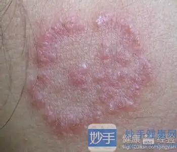 神经性皮炎如何治疗才能好