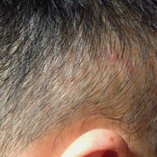 腋下皮囊炎图片