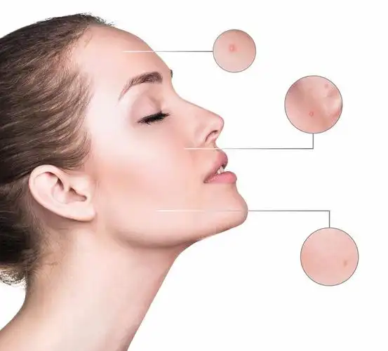 曲洪欣专业祛痘,山东曲尚生物