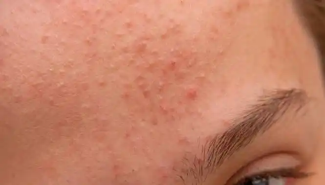 判断脸上有角质的方法 如何判断脸上是否有角质