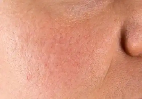 毛孔粗大多半是废了?我能怎么办啊!_皮肤