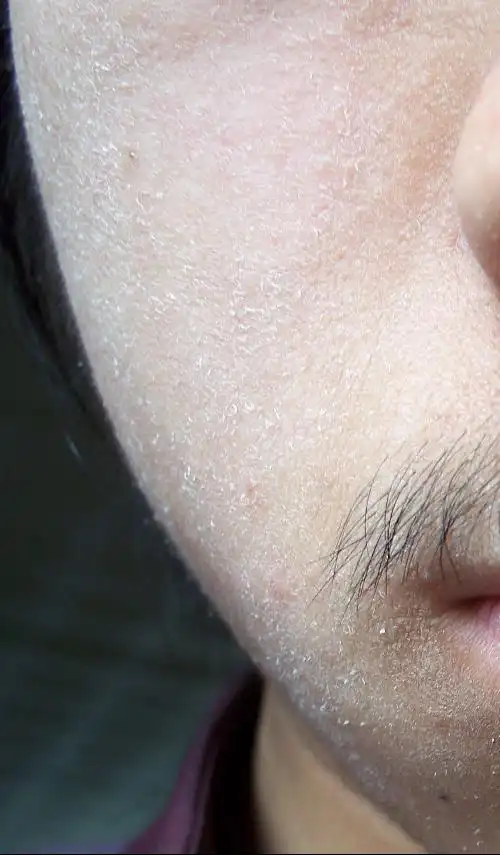 我的脸怎么这么干,是不是山了?