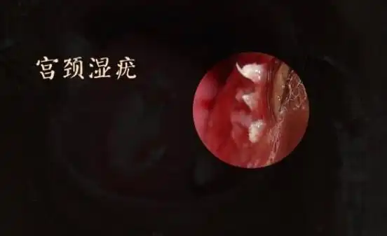 宫颈尖锐湿疣图片