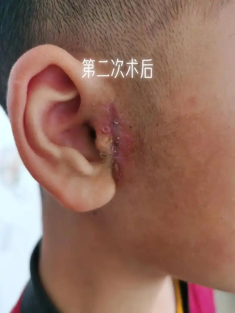 第二手术还是失败,第一次说的是囊肿?第二次说的是耳前瘘管?到 - 抖音