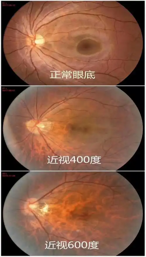 关注66爱眼日除了近视度数高度近视患者还应该关注这些