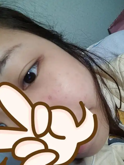 果酸换肤后第三天脸颊结痂掉了一些看着没有前两天吓人了果酸换肤的