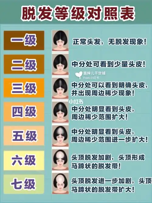 732019脱发等级自测75