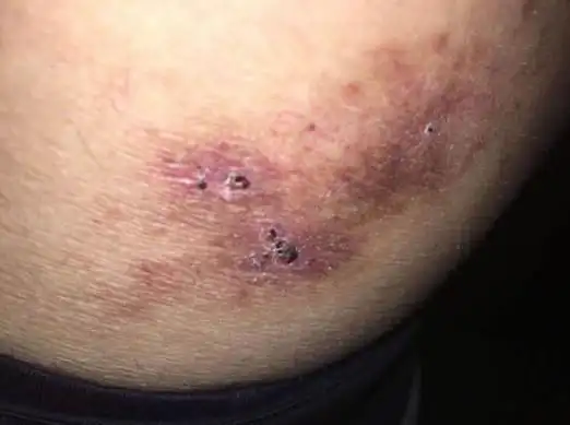 股癣更多见于男性(阴囊可提供潮湿温暖的环境),常与足癣有关,其他易感