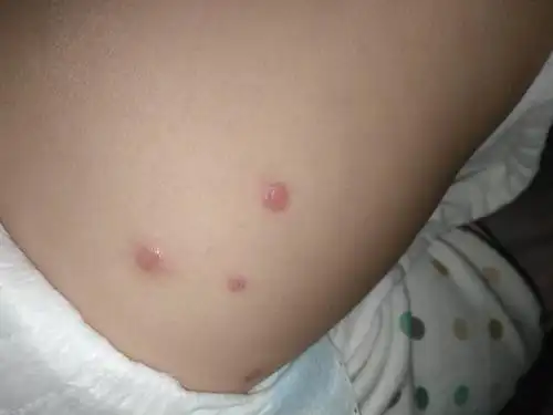 小宝宝身上长这种豆子大的红包,一开始是皮肤微发红,过几天就变