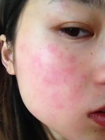 【皮肤过敏】孕妇皮肤过敏症状_皮肤过敏怎么办 - 妈妈帮微专题