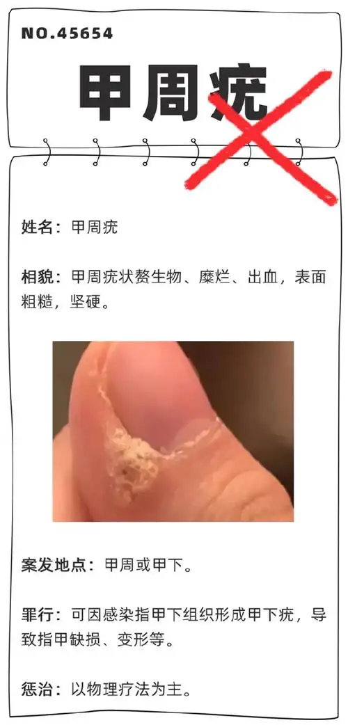 得了皮肤疣会传染吗