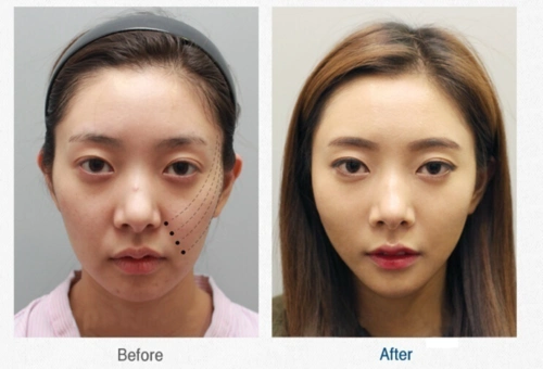 全面部综合年轻化套餐填充塑形