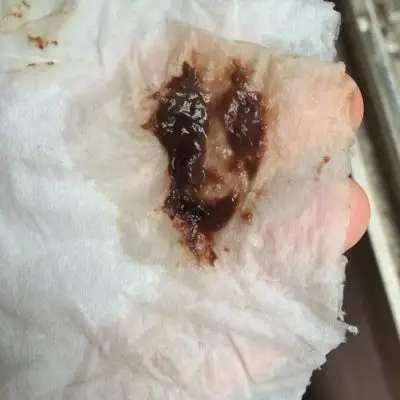 孕10周昨天流出来一块褐色东西,不知道怎么回事,求宝妈们帮帮忙?