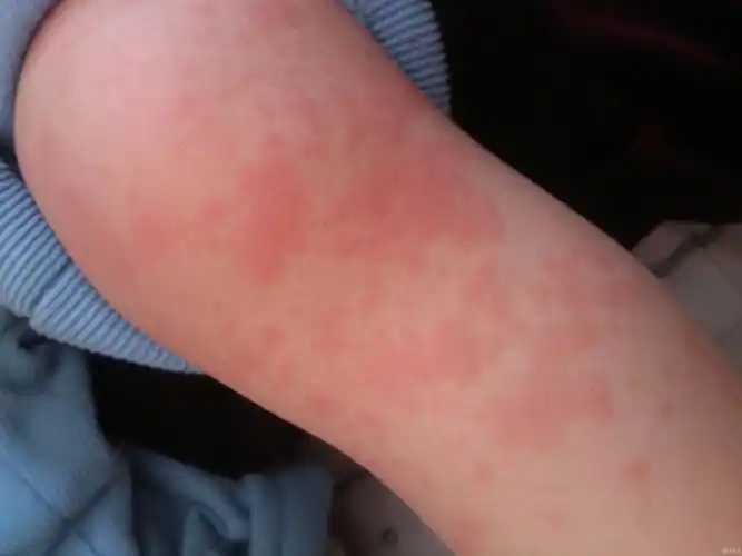 儿子发热皮疹皮肤科怀疑是过敏引起皮疹儿科怀疑是川崎病