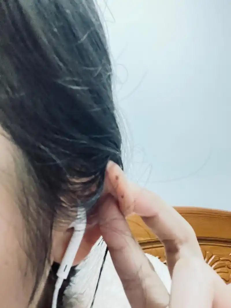 突然发现耳轮上有两个痣
