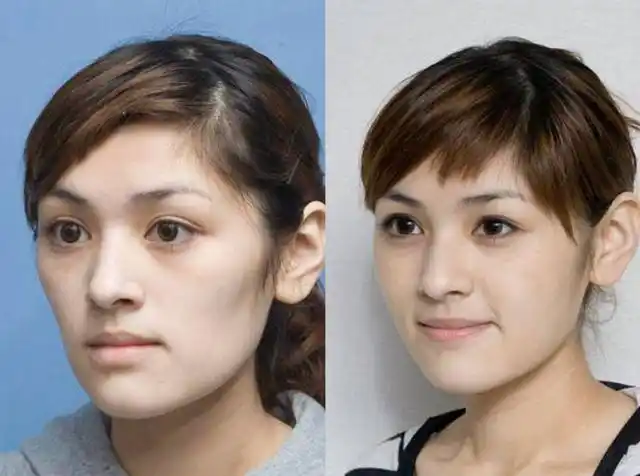 自体脂肪填充面部的4大雷区,填充后能否确保取出?答案来了