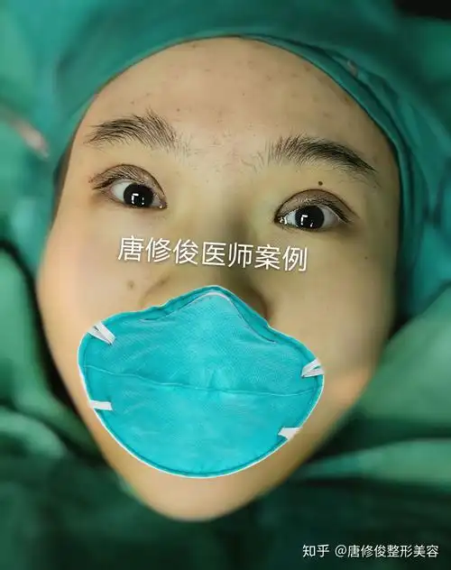 轻度上睑下垂术后五天外观