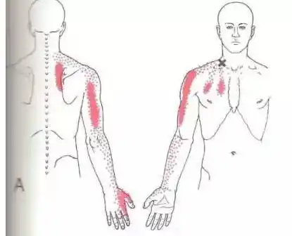 哪些肌肉能引起肩胛骨内侧不适,疼痛?