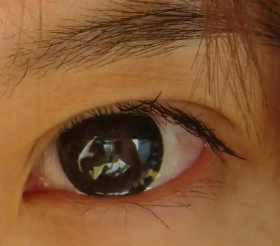 眼睛流泪是什么原因引起的眼睛经常流泪是怎么回事