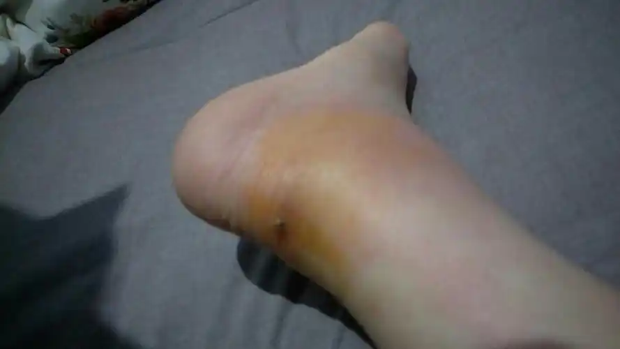 穿衣高跟鞋把脚磨伤然后发炎了,肿了,可以吃阿莫西林吗吗,最好怎么